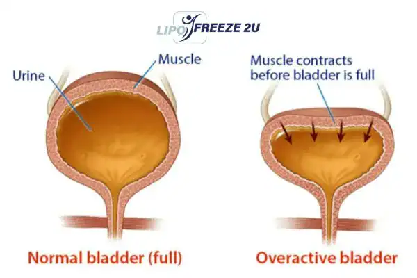 diagram of overactive bladder treatment Hatfield