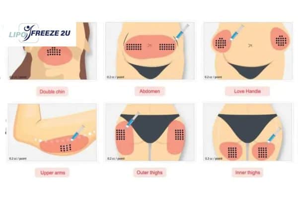Benefits of Choosing Aqualyx for Fat Reduction Hatfield
