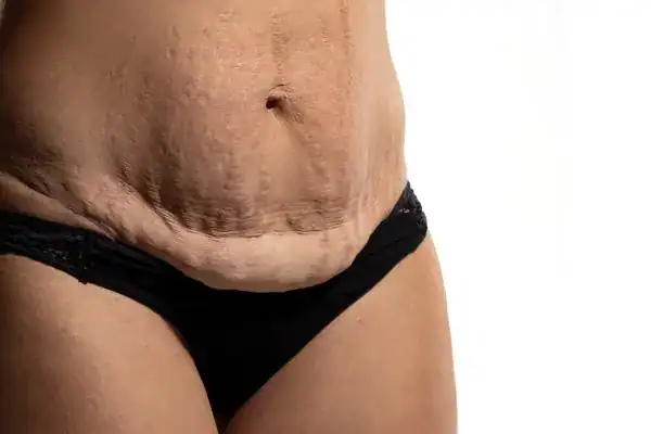loose skin after weight loss injections Hatfield
