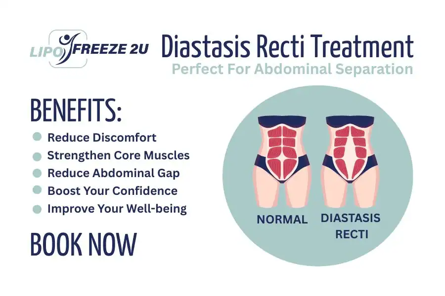 How Long Will It Take to See Improvements in Diastasis Recti Hatfield