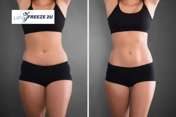 How Can LIPO FREEZE 2U Support Your Post-Pregnancy Body Recovery Hatfield?