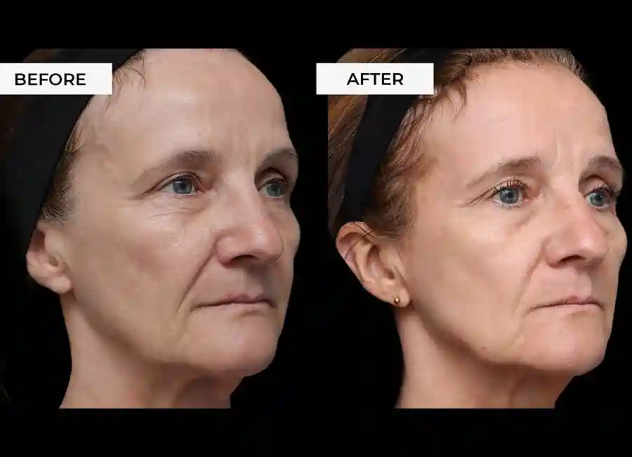 How Many RF Microneedling Sessions Will You Need to See a Difference Hatfield?